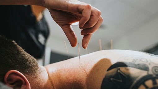 man getting acupuncture in his back and neck for pain relief