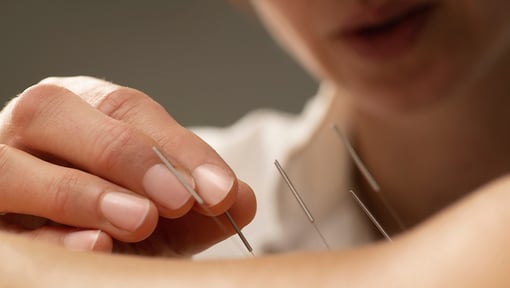 Close-up of hands placing thin acupuncture needles into a person’s skin.